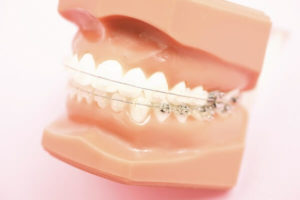 何歳でも歯が健康であれば矯正治療は可能です